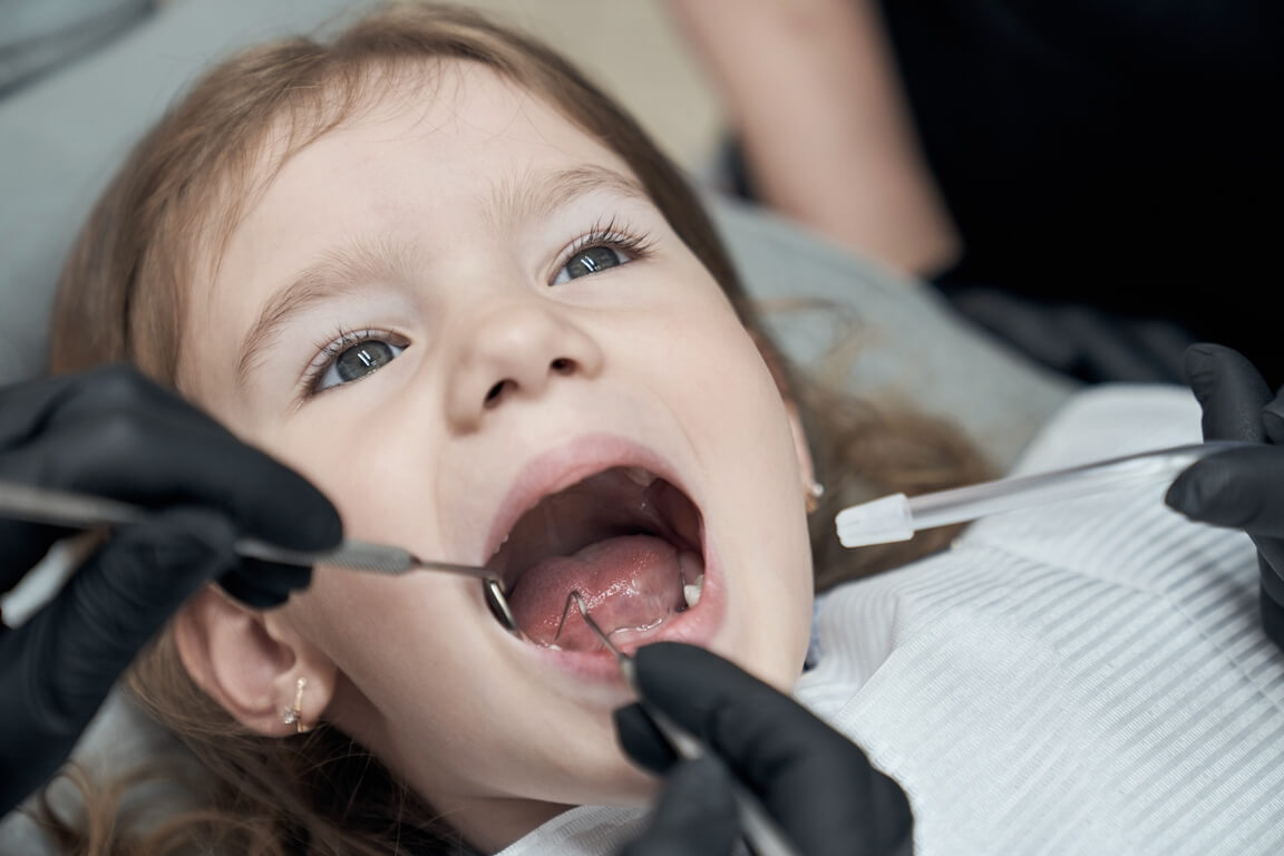 Пломбирование зубов у детей